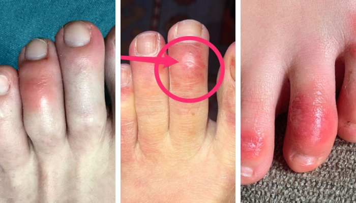 What Is Covid Toes? - Central Health Derby